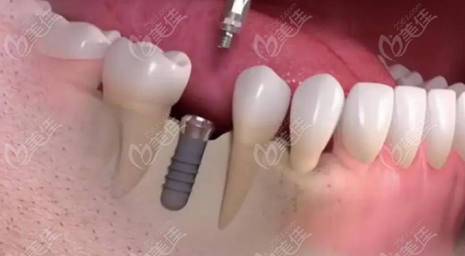 广州拜博口腔种植牙效果如何？价格靠谱吗？-图3