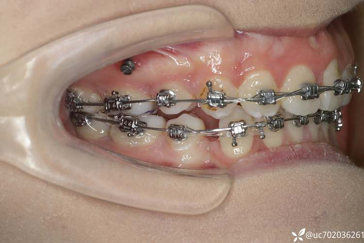 二类错颌畸形手术方法有哪些？选择标准与应用要点是什么？-图1