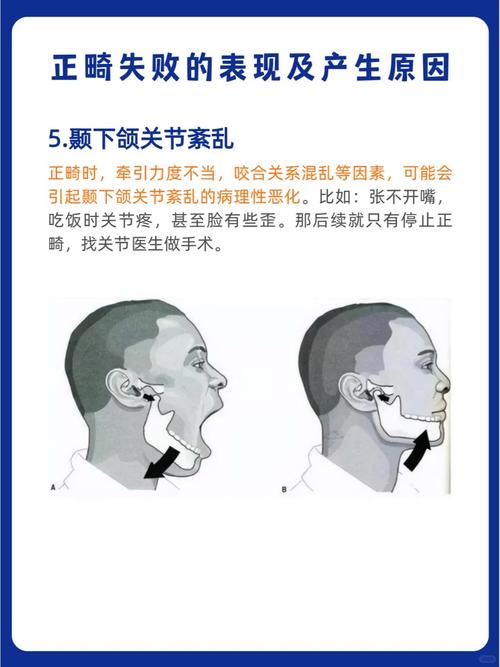 二类错颌畸形手术方法有哪些？选择标准与应用要点是什么？-图3