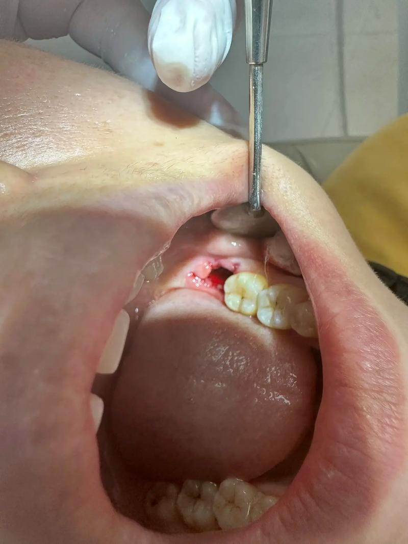 永川拜博口腔拔智齿疼不疼？价格贵吗效果如何？-图2