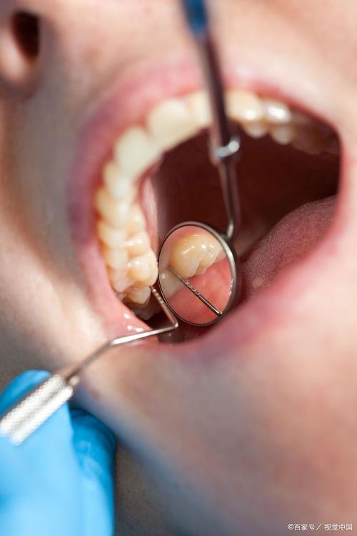 永川拜博口腔拔智齿疼不疼？价格贵吗效果如何？-图3