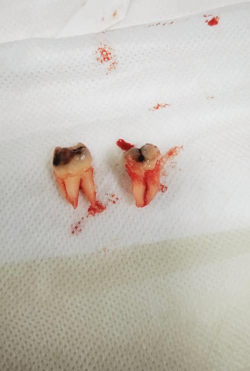 永川拜博口腔拔智齿疼不疼？价格贵吗效果如何？-图1