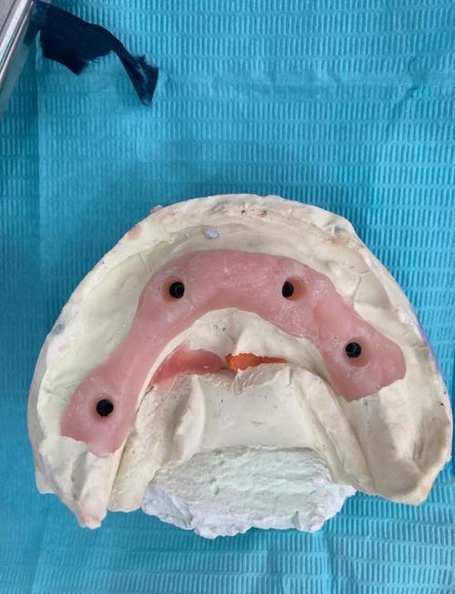 曾经戴过假牙的人,现在还能种牙吗?-图1 曾经戴过假牙的人,现在还能种牙吗?-图1