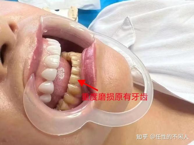 牙茶渍怎么简单变白？有哪些快速有效的方法？-图2