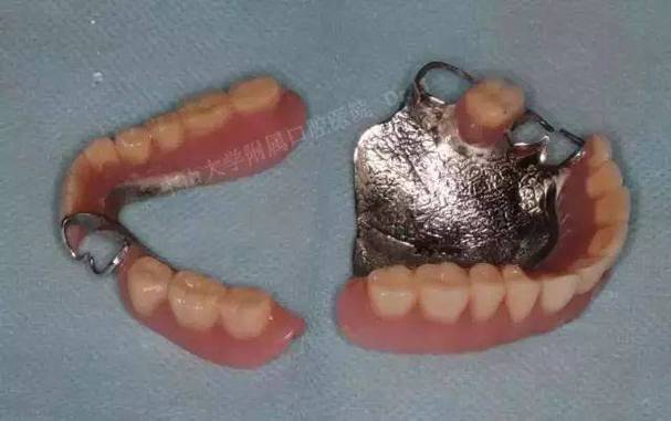 种牙后牙冠有点松动是什么原因？需要立即处理吗？-图2