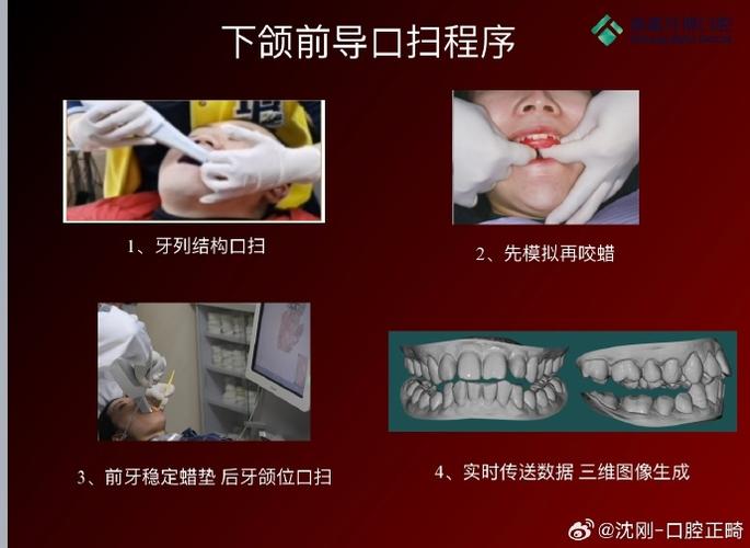 上颌后提区的制作方法应如何规范操作？关键步骤有哪些？-图1