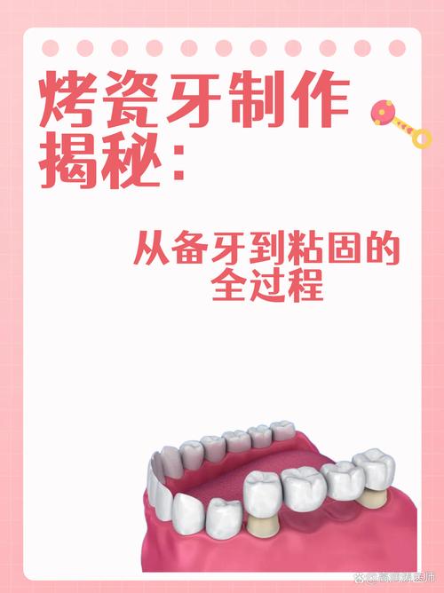 烤瓷牙制作方法图解，从备牙到戴牙的完整制作步骤图解是怎样的？-图2