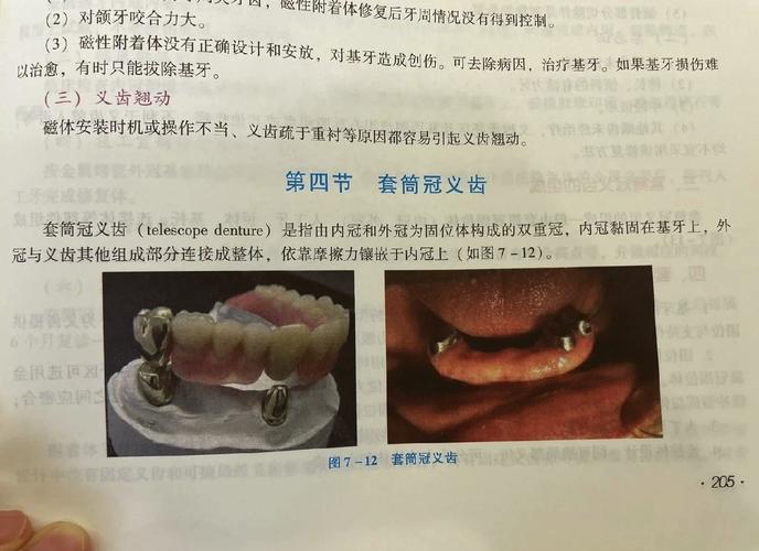 口腔用起冠器如何正确使用？步骤与方法详解-图1