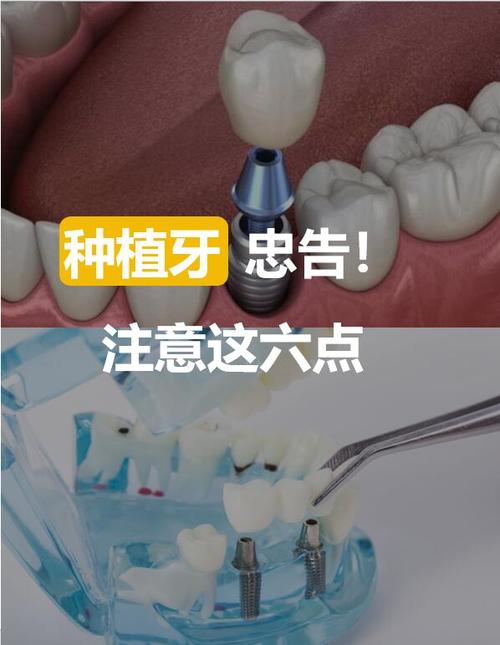 种植牙可以种黄金吗？黄金种植牙是否可行？-图2