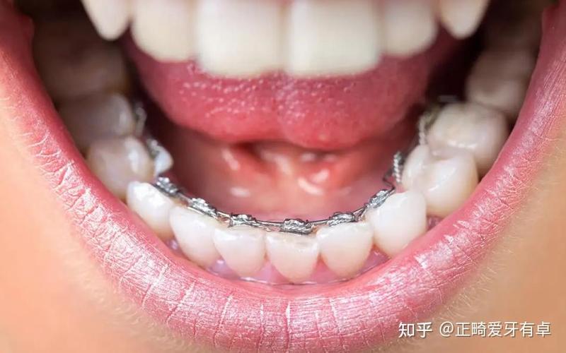 标准舌侧正畸弓形图下载渠道有哪些？-图1