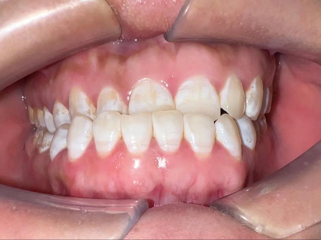 杭州拜博口腔地包天-图2