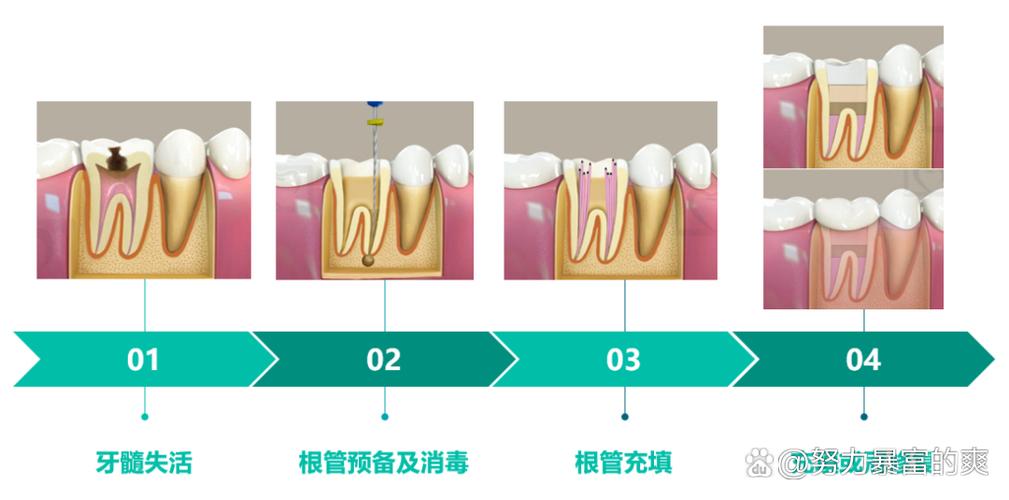 根管消毒的方法有哪些-图2