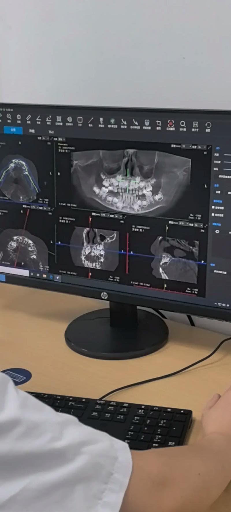 拜博口腔超声刀拔牙优势有哪些？-图3