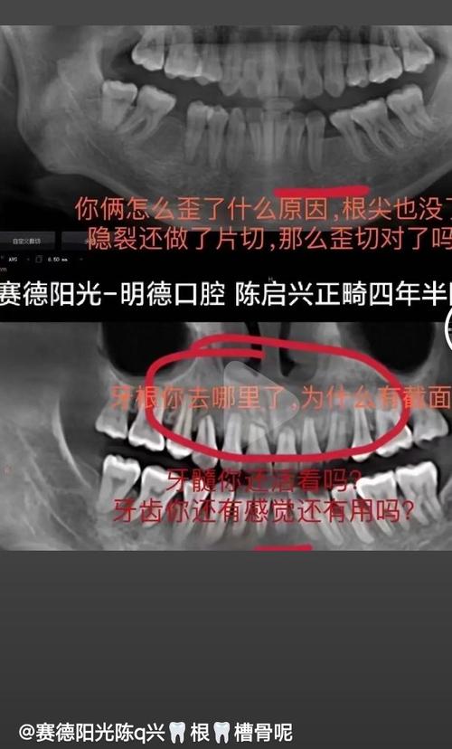 正畸过程中牙齿断了，该怎么办？-图1