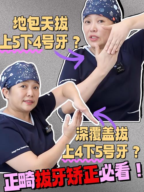 正畸拔4颗和5颗牙区别在哪？-图3