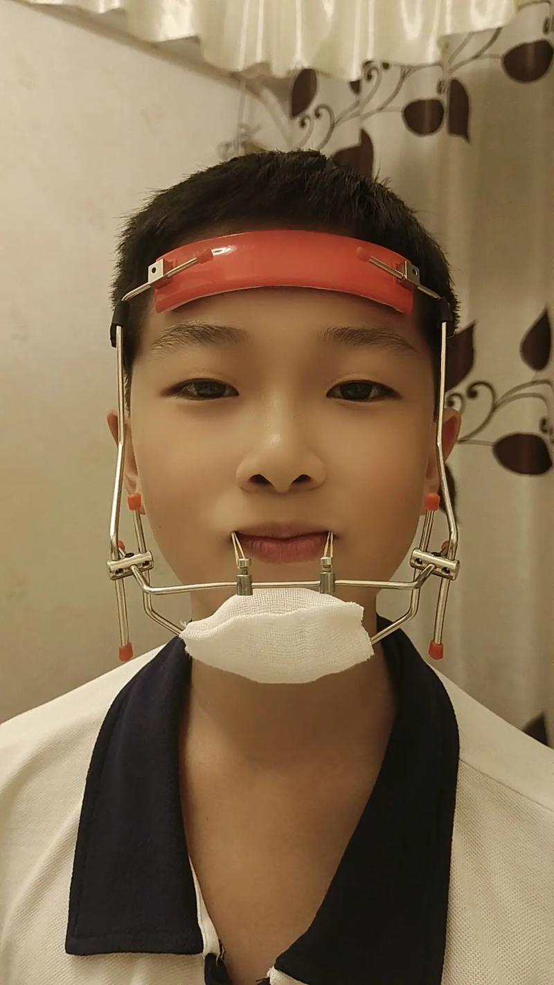正畸前方牵引器怎么佩戴？教程步骤详解-图1