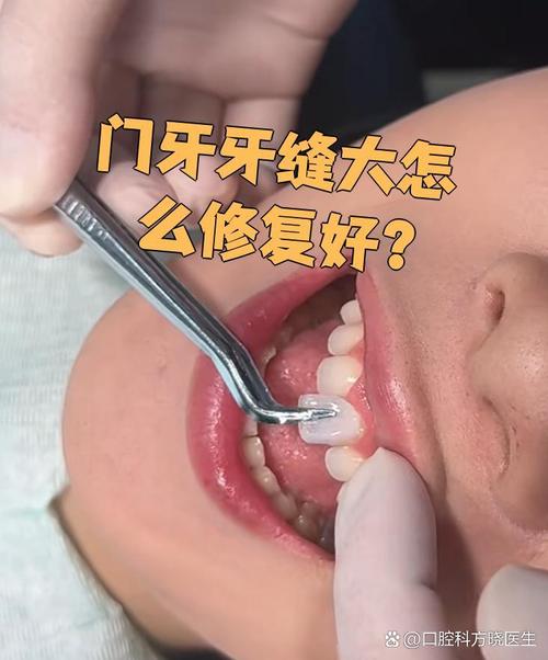 前牙牙缝大如何修补?有哪些有效方法?-图2 前牙牙缝大如何修补?有哪些有效方法?-图2