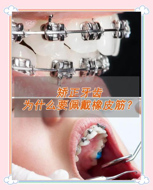 正畸刚用皮筋该用哪个号-图3