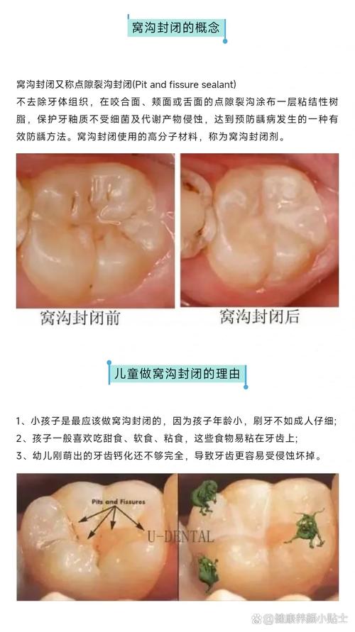 窝沟固化的方法不包括哪些具体操作？-图1