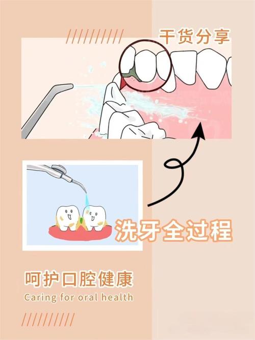 超声波洁牙的方法步骤-图1