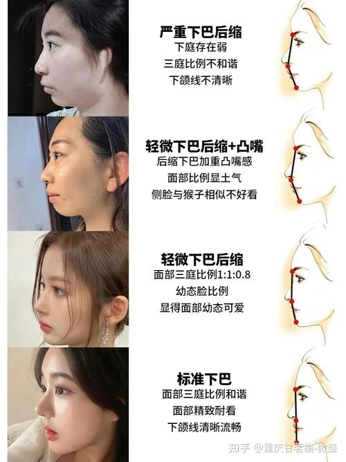 如何改善下颌骨后缩？有哪些可行方法？-图3