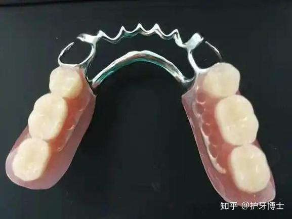 牙齿搭桥的方法好不好-图1