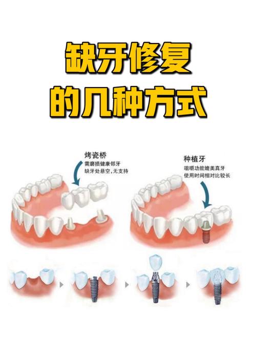 牙齿搭桥的方法好不好-图2