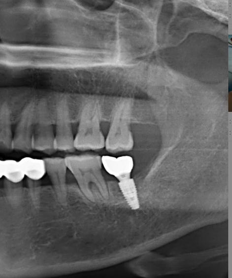 温州牙科医院种牙效果如何？技术、价格、服务、口碑靠谱吗？-图2