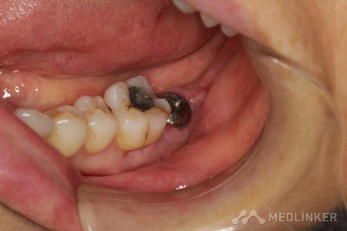 种牙后的牙齿图片大全能看出哪些真实效果？美观度和自然度跟真牙比如何？-图1