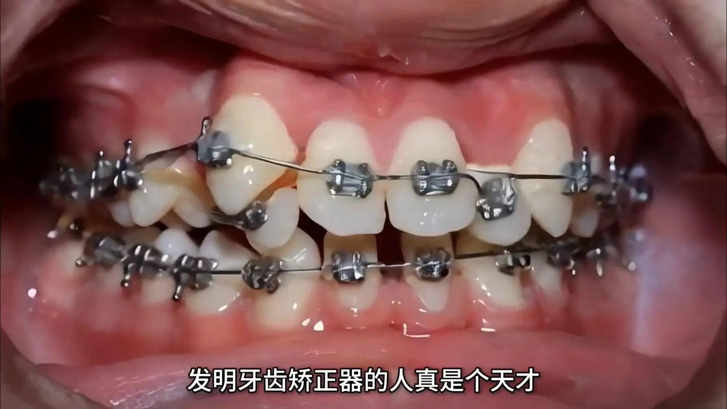 日本牙齿正畸技术怎么样？效果和安全性如何？-图1
