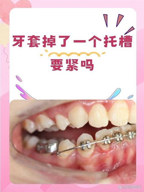 正畸矫正必须所有牙都粘托槽吗？-图3