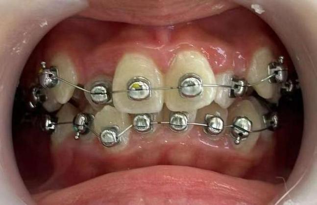 正畸矫正必须所有牙都粘托槽吗？-图1