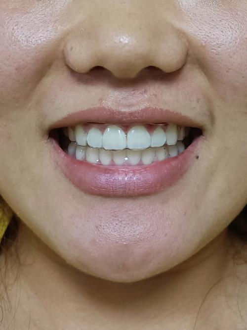 正畸后牙齿出现牙缝，究竟是什么原因造成的？-图1