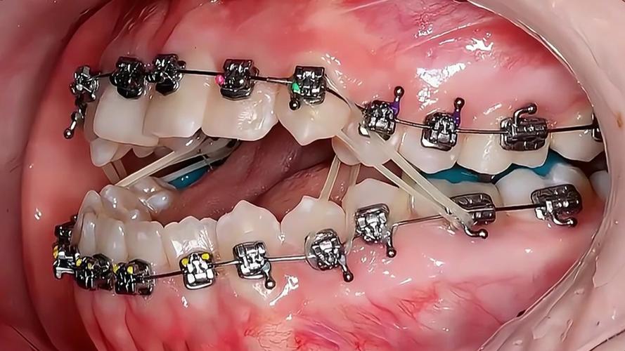 开颌手术可以不做正畸直接进行吗？-图1