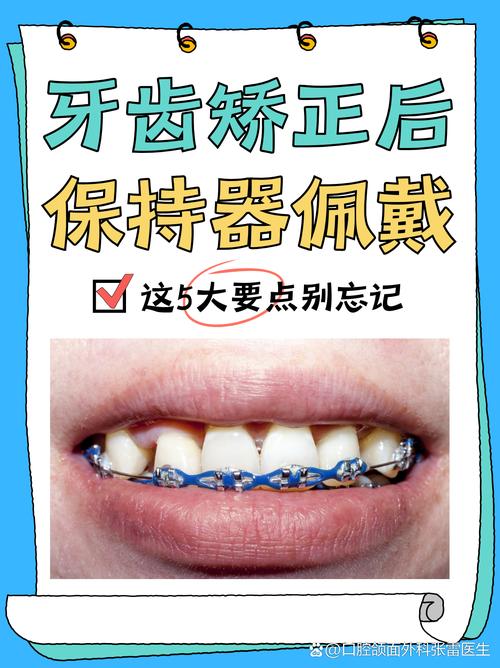 保持器的弯制方法正畸-图1