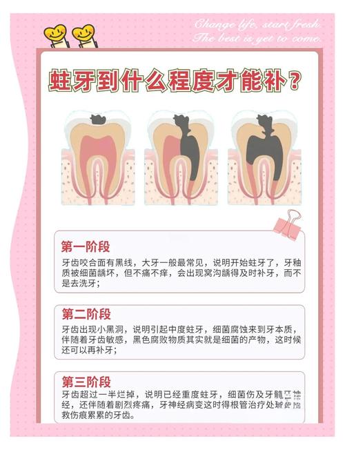 蛀牙牙齿怎么治疗？有哪些有效方法可选？-图2
