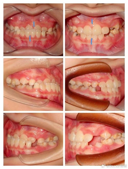 反颌偏颌，掩饰性正畸矫正效果如何？-图1