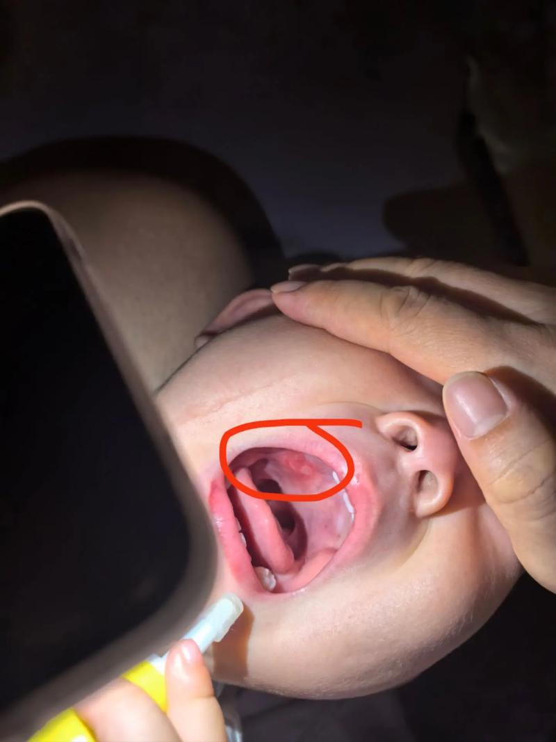 两岁宝宝口腔溃疡，拜博能治好吗？-图1