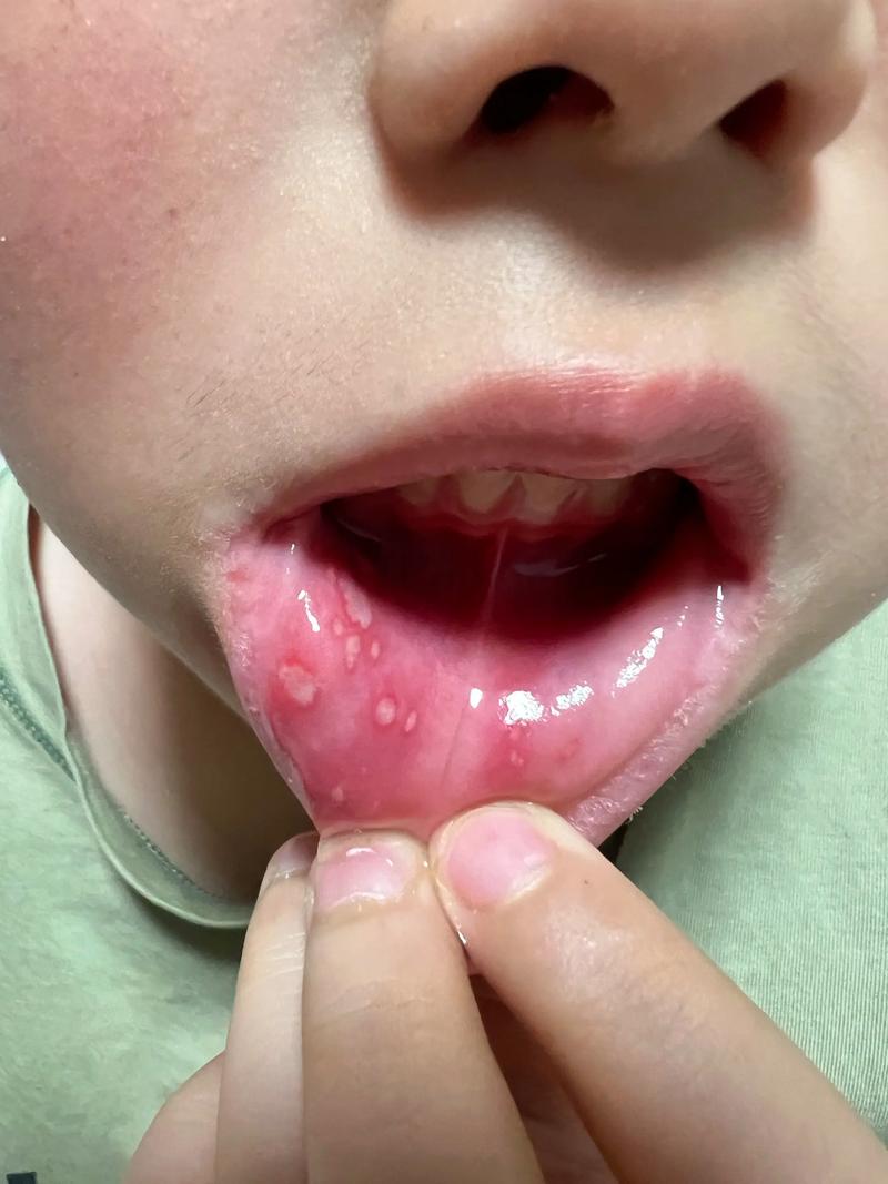 两岁宝宝口腔溃疡，拜博能治好吗？-图2