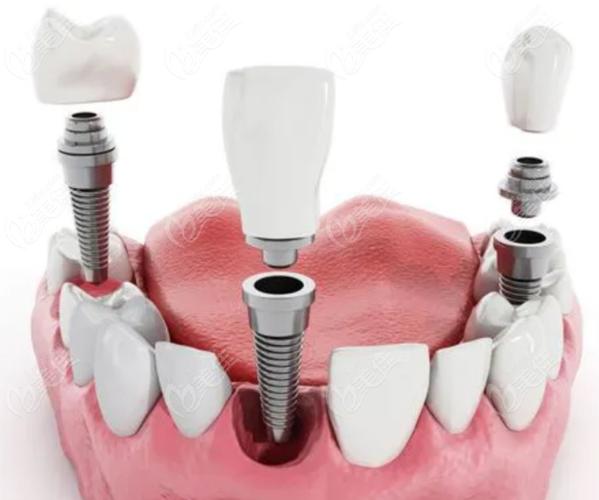 拜博口腔科种植牙靠谱吗?价格怎么样呢?效果能管多久?有保障吗?-图2 拜博口腔科种植牙靠谱吗?价格怎么样呢?效果能管多久?有保障吗?-图2