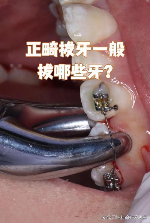 正畸减数拔牙是什么意思-图3