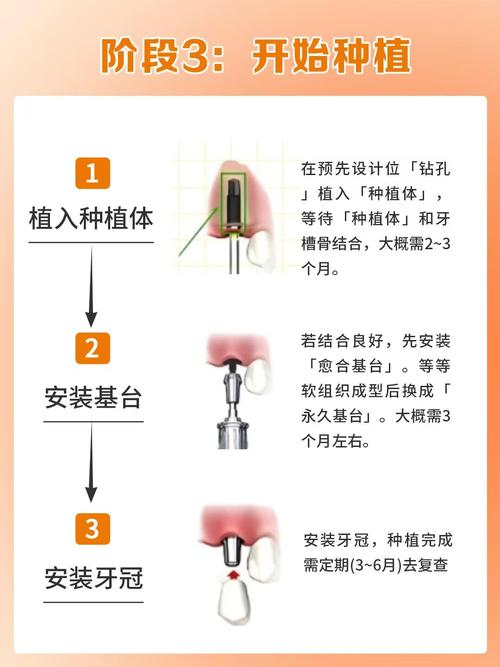 种植牙机的具体使用方法步骤是怎样的？-图1
