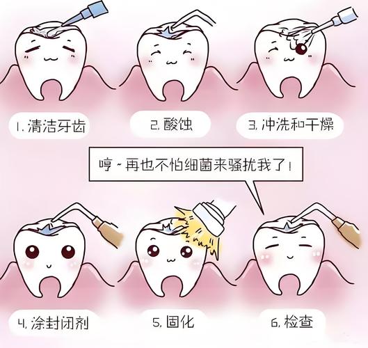 窝沟封闭的方法和步骤是怎样的?具体操作流程如何?-图3 窝沟封闭的方法和步骤是怎样的?具体操作流程如何?-图3