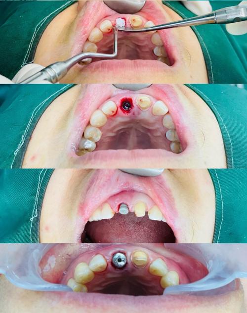 青岛亚美口腔医院种牙效果怎么样？技术靠谱吗？价格贵不贵？-图3