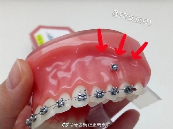 正畸支抗钉可以重复使用吗？重复使用的安全性与效果如何？-图3