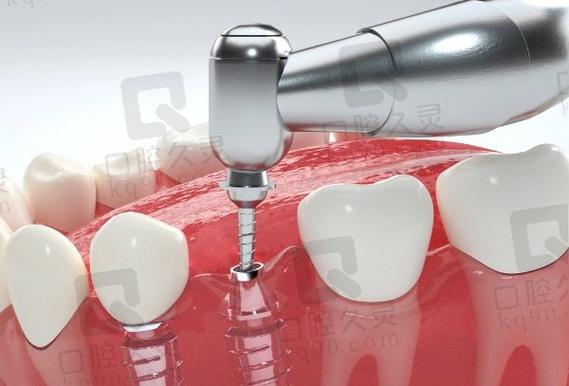 上海拜博口腔植牙价格效果如何？技术靠谱吗？-图1