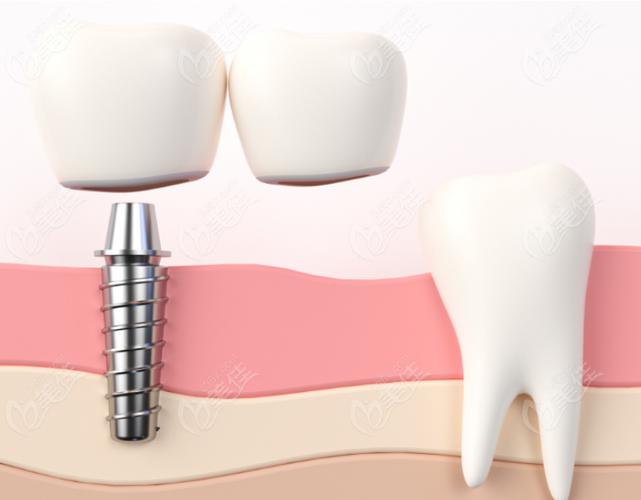 上海拜博口腔植牙价格效果如何？技术靠谱吗？-图2