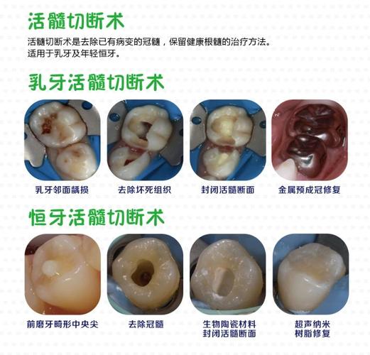 保存活髓的治疗方法有哪些？各自适用情况及优缺点是什么？-图3