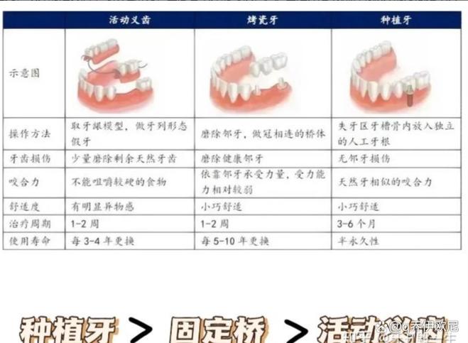 青年种牙好还是镶牙好-图3
