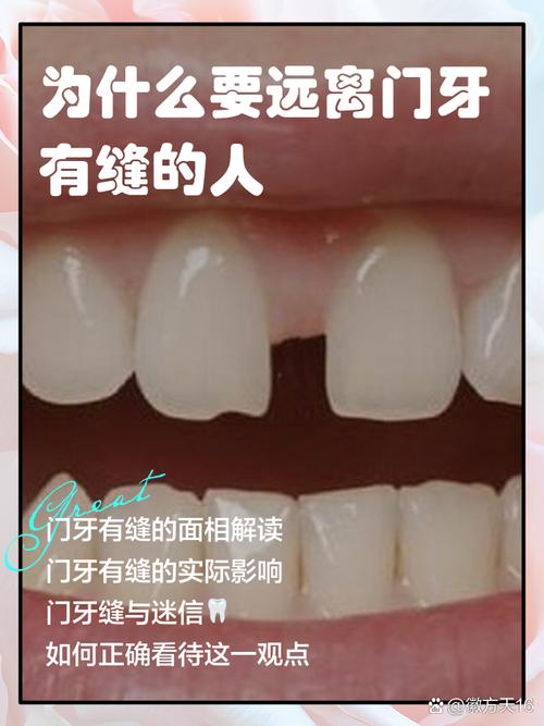 门牙牙缝变小的方法有哪些？-图3